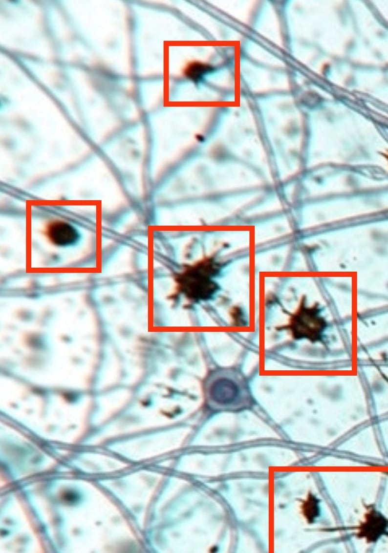 Les nanoparticules ciblent de nouvelles voies pour lutter contre la maladie d’Alzheimer